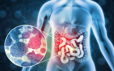 Cáncer colorrectal aumenta en México y afecta cada vez más a personas menores de 40 años