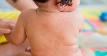 Muere bebé de 1 año por sarampión en Tlaxcala; no tenía la vacuna